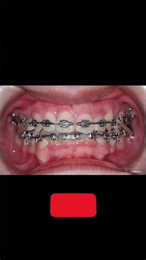 “Amazing Teeth Correction Transformation | Before & After Orthodontic Fix”