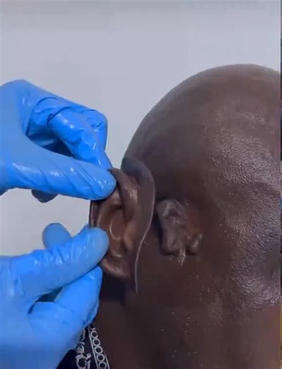 DIMA on Instagram: "Prosthetics are more than devices — they are a bridge between loss and possibility. This video highlights how modern prosthetic technology restores movement, independence, and confidence, combining medical science, biomechanics, and human resilience. From design to function, prosthetics represent innovation that truly changes lives. #Prosthetics #ProstheticLimb #MedicalTechnology #Rehabilitation #Biomechanics OrthoticsAndProsthetics HumanBody Anatomy HealthcareInnovation Mobi