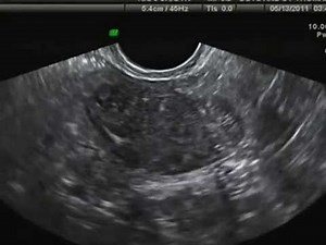 Hysterosalpingo-contrast-ultrasonography (HyCoSy)