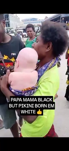 This person has never seen a Albino child in his life 🤣🤣😂😂😂 oh Sepik people 🤦🏽 | Real PNG