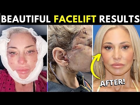 How One 50-Year-Old Turned Back the Clock Ten years! Facelift & Fat Transfer Transformation