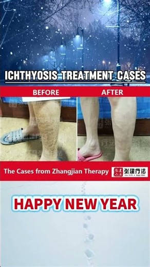 Effective ichthyosis treatment solve ichthyosis #ichthyosistreatment#ichthyosis#ichthyosisvulgaris