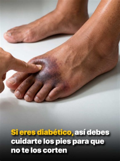 Si eres diabético, así debes cuidarte los pies para que no te los corten.