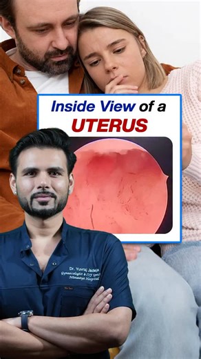 Dr Yuvraj Singh Jadeja | Gynaec & IVF specialist on Instagram: "Inside a real uterus. Hysteroscopy is a real procedure done with inserting camera in the uterus from the vagina and to check every thing cervix uterus tubal opening etc . . . . . Fertility specialists, best fertility specialists, gynaecologist in vadodara, gynaecologist in Anand, gynaecologist in ahemdabad, infertility specialist in Vadodara, ahmedabad, Mumbai, Anand, Bahruch , best ivf doctor, best fertility specialist, best gynaec