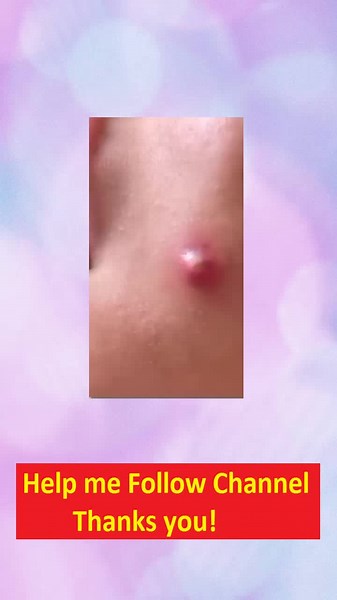 Acne Popping on TikTok