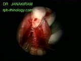 Right Maxillary Sinus Lesion • Video • MEDtube.net