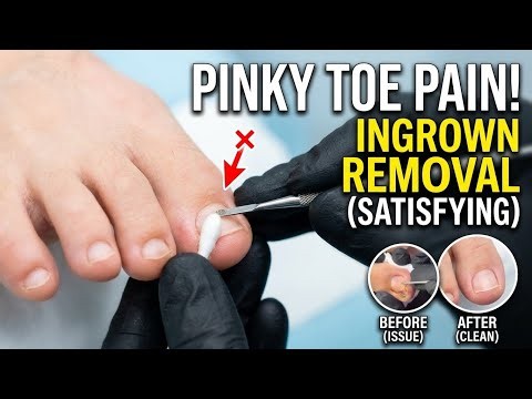 Ingrown toenail removal pinky toe