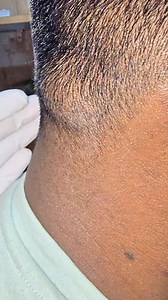 293K views · 556 reactions | Scalp Lipoma | Dr. Khaled Hasan Milu | Facebook