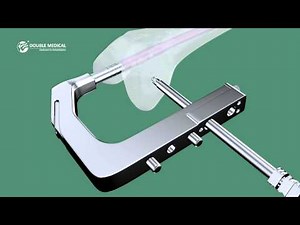 Distal Femoral Nail II