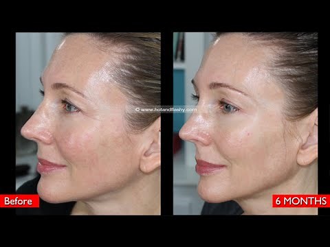 My Fraxel Dual 6 Month Update!