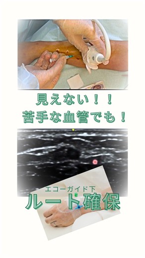 「点滴ルート確保にエコーを使ってみよう！」