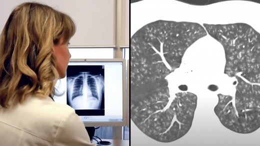 Doctor shows x-ray of 'popcorn lung' caused from vaping and it can be fatal