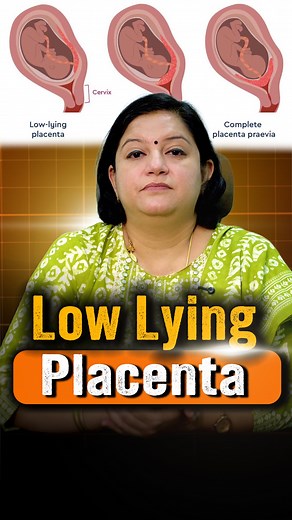 Dr.M.H.Abinaya Baskaran on Instagram: "A young mother recently came in after her NT scan at 14 weeks, confused and scared about her low-lying placenta. Her mind was filled with questions. Will my pregnancy continue? Will my baby bleed during labor? What should I eat? Let’s clarify: 🔹 No diet, yoga, or medicine can make the placenta go up 🔹 Precautions matter, avoid lifting, long travel, or intimacy 🔹 Progesterone may be given only if spotting occurs 🔹 In most cases, the placenta naturally mo