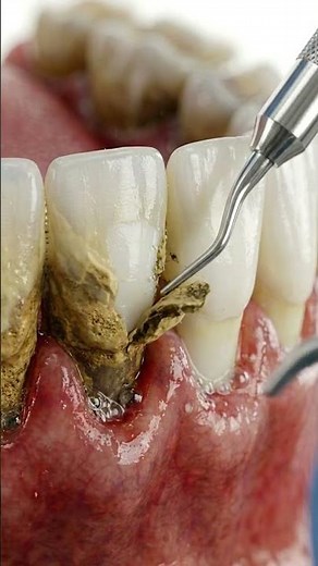 Severe Plaque Buildup Removal Transformation #beforeafter #teethdecay