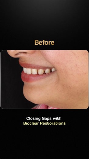 Closing gaps using bioclear restoration #vedadentistry #gapclosure