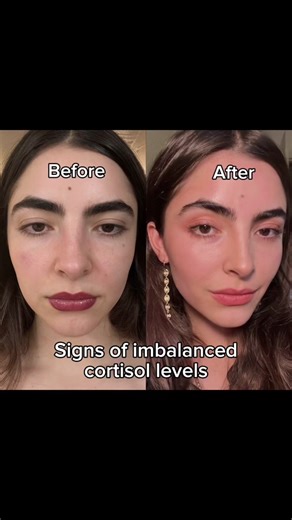 Balancing Cortisol and PCOS: Tips and Solutions for Hormone Imbalance