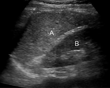 Ultrasound - Abdomen