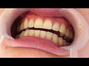 Dr. Stil - Brackets und feste Zahnspange- was passiert am ersten Tag