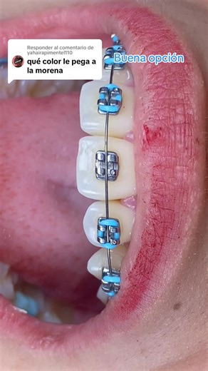 Brackets en Colores: Celeste o Turquesa para Morenas