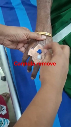 cannula remove ✅