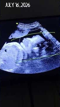 Pregnancy Journey|Tdap Vaccine|3d/4d ultrasound