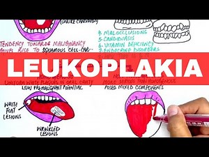 Leukoplakia - Causes, Diagnosis & Treatment
