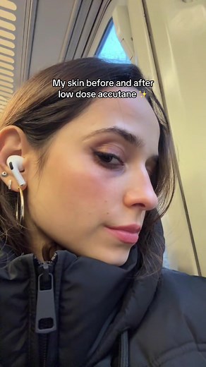 Transform Your Skin: Accutane Before and After