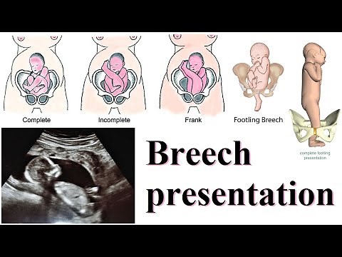 breech presentation