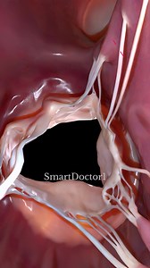Right ventricle 🫀🩺 . . . The right ventricle is one of the four chambers of the heart. Here are some key points about it: Structure Location: Located on the lower right side of the heart. Shape: Cone-shaped and has thinner walls compared to the left ventricle. Function Role in Circulation: Responsible for pumping deoxygenated blood to the lungs via the pulmonary artery. Valves: Contains the tricuspid valve, which separates it from the right atrium, and the pulmonary valve, which leads to the p