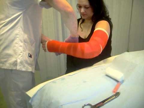 Broken arm putting on new gypsum