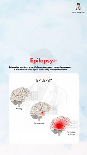 ⚡F_A_I_J_U_R⚡ | Epilepsy:- Epilepsy is a long-term (chronic) disease that causes repeated seizures due to abnormal electrical signals produced by damaged... | Instagram