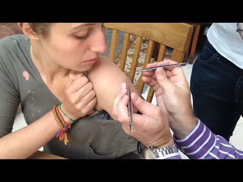 Bot Fly Removal Girl 😱. #bot #botfly #removal #girl #girls #youtube #video 