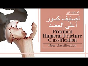 proximal humeral fracture classification - Neer classification