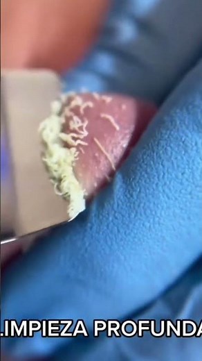 Satisfying Blackhead Removal on Nose – Step by Step at Home! #blackheadremoval #asmr #skincare