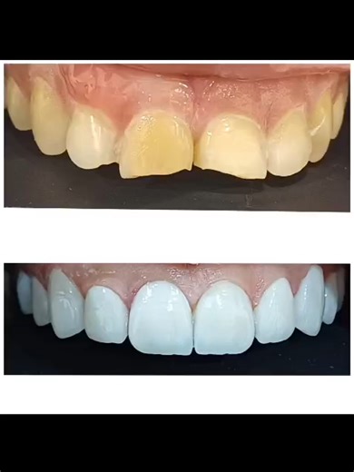 #oceanmedicalcentre #dohaqatar #qatarphilippines #qatarliving #filipinoqatar #QA #qa #cosmeticdentistry #dentalhealth #indianqatar🇮🇳🇶🇦 #offer #qataroffers #malayaliqatar #freeCONSULTATION@priyajayachandran6