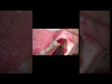 “Wisdom Tooth Extraction Procedure | Step-by-Step Dental Guide