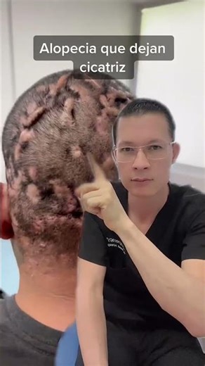celulitis disecante