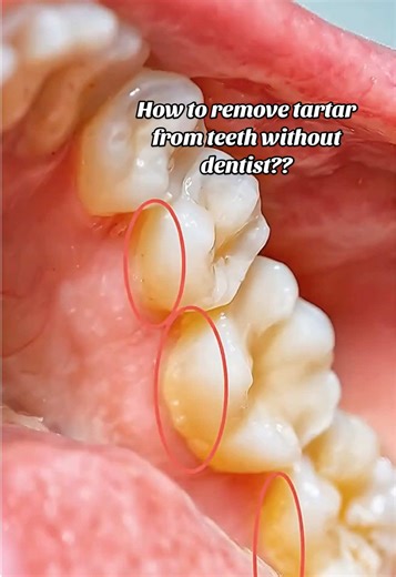 Effective Methods to Remove Tartar from Teeth at Home