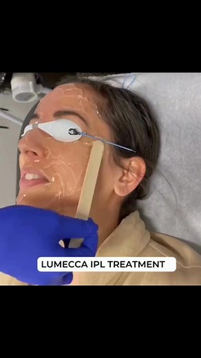 Lumecca IPL treatment #beauty #skincare #shorts | Jeanne Wilcox