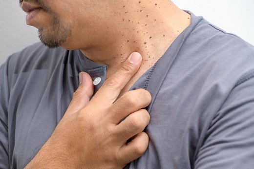What exactly causes skin tags? Here's what dermatologists have to say.