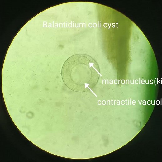 Stool microscopy/Balantidium coli cyst