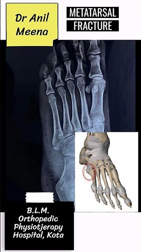 Metatarsal fracture recovery Time | metatrsal fracture healing time | base of 5 metatarsal fracture