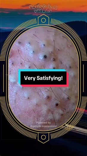 Blackheads Removal: Pimple Patch Skincare That Really Works