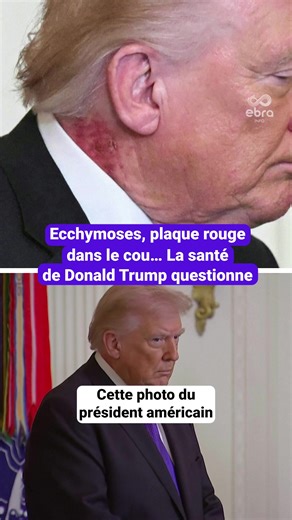 Plus vieux président américain jamais élu, Donald Trump a également son lot de problèmes de santé. Ce lundi 2 mars, on pouvait voir une plaque rouge dans son cou, lors d’une cérémonie à la Maison-Blanche. Elle serait due à l’application d’un traitement « préventif », selon son médecin, mais qui vient relancer les questions sur l'état de santé du chef d'État. #ebrainfo #sinformersurtiktok #tiktoknews #iran #donaldtrump