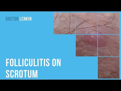 😕 Folliculitis on scrotum