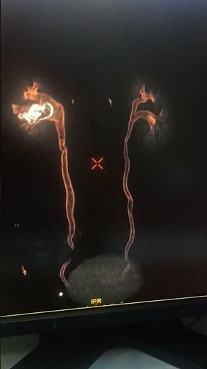 CT urography 3D #anatomy Post contrast #ct #ct scan