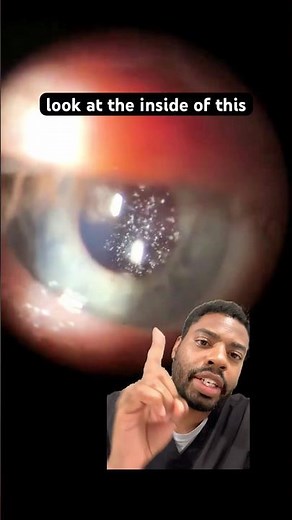 Asteroid Hyalosis (Vision)