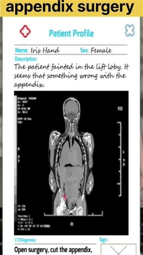 appendix surgery 3d animation #shorts
