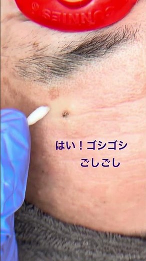 お顔のイボは、思ったより老けて見えます💦 レーザー治療で簡単に除去できるのでお気軽にご相談ください✨ #美容皮膚科 #レーザー治療 #イボ取り#美肌治療 #渋谷スキンクリニック