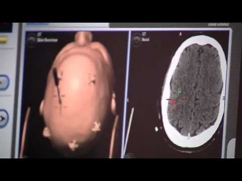 AutoLITT - A Minimally Invasive Brain Tumor Treatment